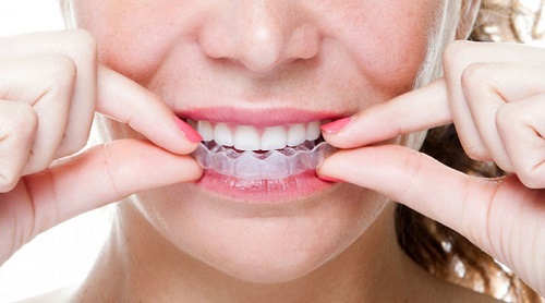 Niềng răng hàm trên mất bao lâu? Quá trình có khác niềng răng nguyên hàm không