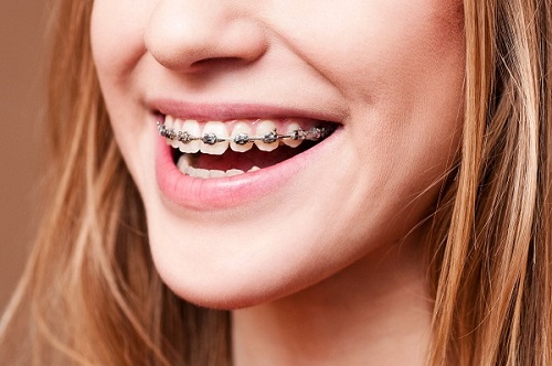 Răng bị hô chìa ra ngoài - Niềng răng hô mất bao lâu là có kết quả