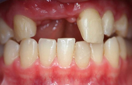 Quá trình thực hiện trồng răng có đau không? 2