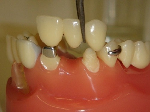 Các kỹ thuật trồng răng sứ đảm bảo an toàn