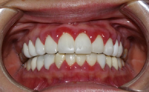 Lắp răng sứ bị sưng lợi - Cách khắc phục và phòng tránh