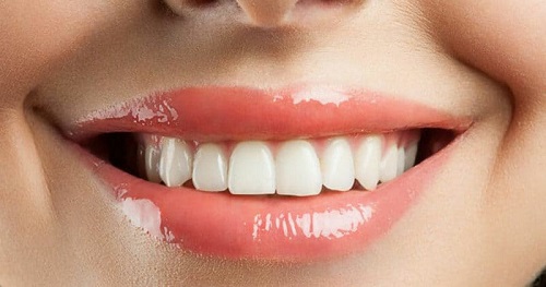 Câu hỏi: Làm răng sứ có niềng răng được không?