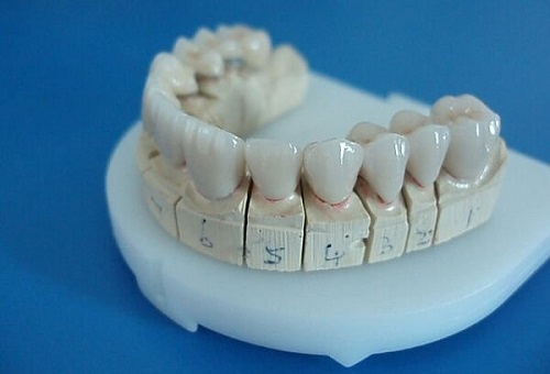 Làm răng sứ sau bao lâu thì hết ê buốt? Cách chăm sóc răng sứ