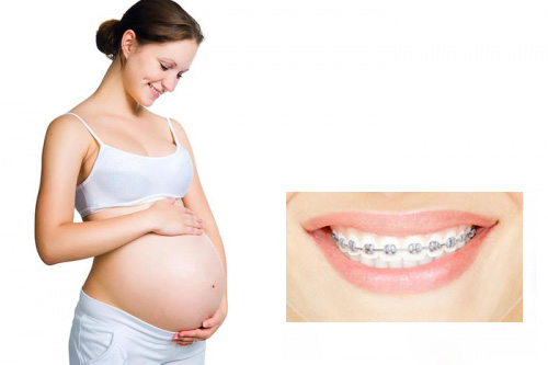 Niềng răng khi mang thai có thực sự nên làm không?