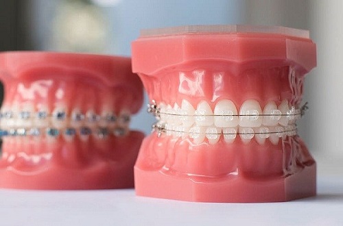 Phương pháp niềng răng làm răng lung lay có sao không