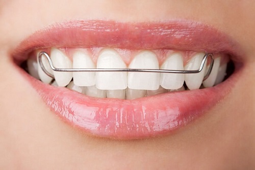 Niềng răng phải đeo hàm duy trì bao lâu là tốt nhất?