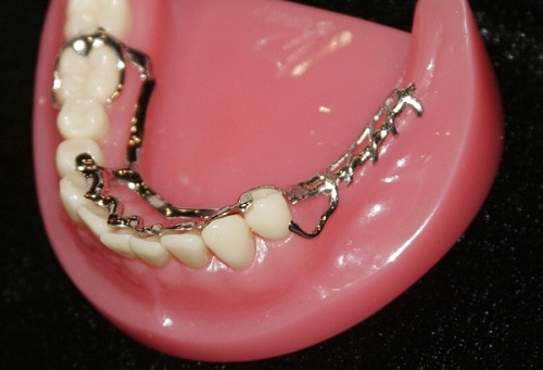 Niềng răng phải đeo hàm duy trì bao lâu là tốt nhất?