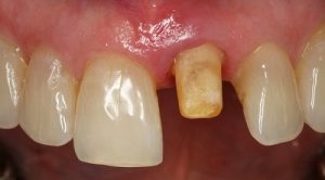 3 nguyên nhân dẫn đến tình trạng răng sứ bị hở