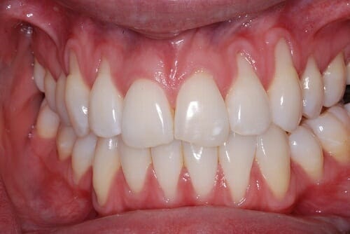 3 nguyên nhân dẫn đến tình trạng răng sứ bị hở 
