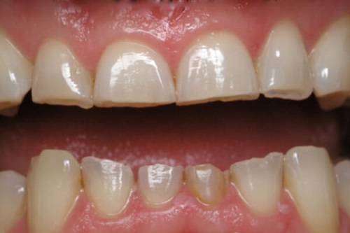 Tình trạng răng sứ bị mòn là do đâu?