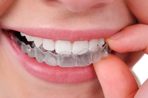 Tình trạng răng sứ bị mòn là do đâu?