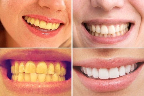 Tác hại của việc tẩy trắng răng mà bạn cần phải biết
