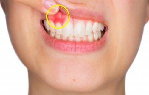 Tác hại của việc tẩy trắng răng do lạm dụng dịch vụ tẩy trắng