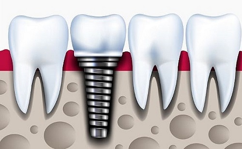 Trồng răng sứ bị nhức - Cách xử lý hiệu quả