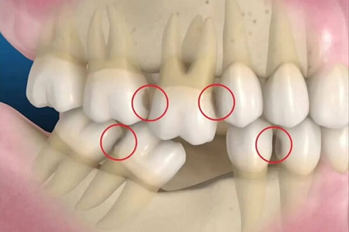 Trồng răng sứ có ảnh hưởng gì không? Chuyên gia giải đáp