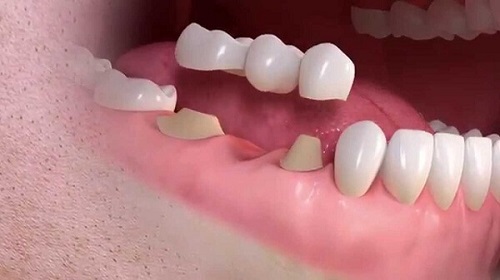 Trồng răng sứ có ảnh hưởng gì không? Chuyên gia giải đáp