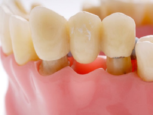 Trồng răng sứ có bị hôi miệng không? Chia sẻ từ khách hàng
