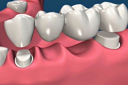 Trồng răng sứ có lâu không? Quy trình thực hiện