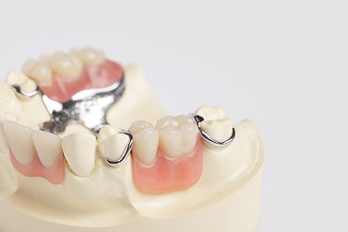 Trồng răng sứ mất thời gian bao lâu? Cách thực hiện