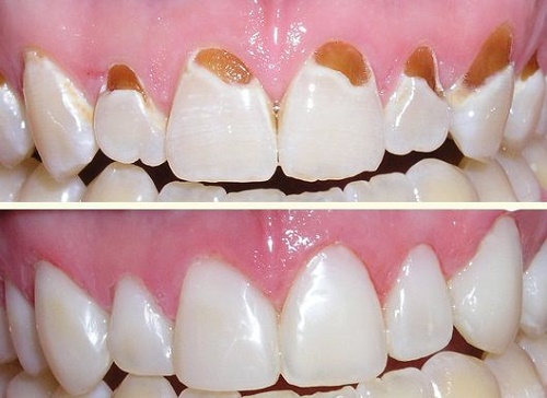 Trám răng có đau không? Chia sẻ thực tế từ khách hàng 1