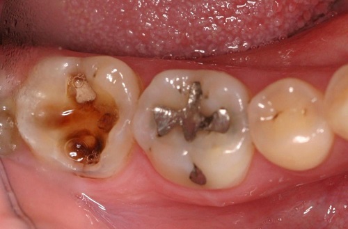 Trám răng duy trì được bao lâu vậy bác sĩ? 1