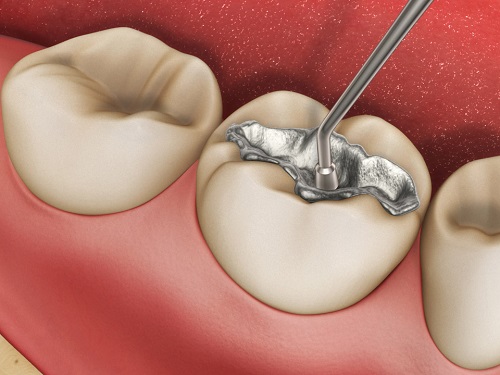 Trám răng duy trì được bao lâu vậy bác sĩ? 2