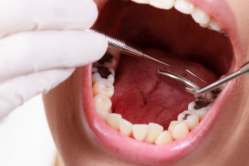 Trám răng duy trì được bao lâu vậy bác sĩ? 3 Trám răng duy trì được bao lâu vậy bác sĩ? 3