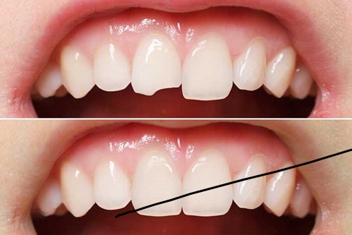 Trám răng thẩm mỹ ở đâu tốt hiện nay? Cần lưu ý điều gì 2 Trám răng thẩm mỹ ở đâu tốt hiện nay? Cần lưu ý điều gì 2