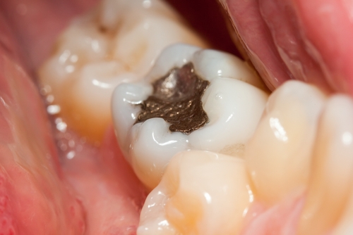 Trám răng có phải lấy tủy không? Nên áp dụng với trường hợp nào 3 Trám răng có phải lấy tủy không? Nên áp dụng với trường hợp nào 3