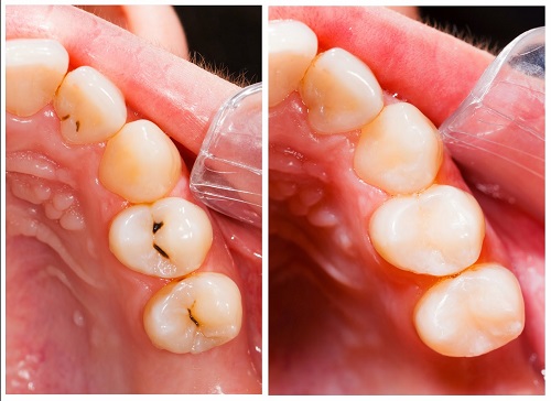 Trám răng có tốt không? Nên áp dụng với trường hợp nào? 1