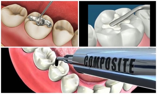 Trám răng cửa bao nhiêu tiền? Tham khảo bảng giá mới 2 Trám răng cửa bao nhiêu tiền? Tham khảo bảng giá mới 2