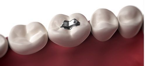 Trám răng bằng amalgam là gì? Cách thực hiện 1