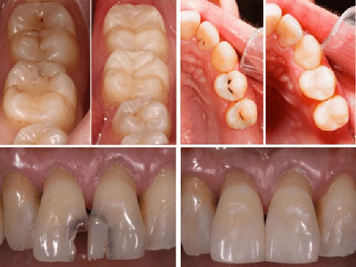 Trám răng bằng amalgam là gì? Cách thực hiện 2