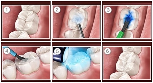 Trám răng bằng amalgam là gì? Cách thực hiện 3