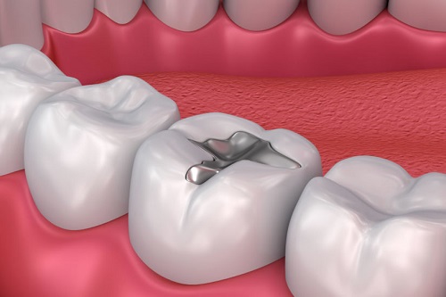 Trám răng bị nhức và đau - Nguyên nhân và cách xử lý 1 Trám răng bị nhức và đau - Nguyên nhân và cách xử lý 1
