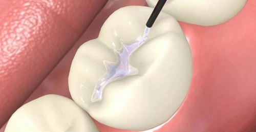 Trám răng bị nhức và đau - Nguyên nhân và cách xử lý 2 Trám răng bị nhức và đau - Nguyên nhân và cách xử lý 2