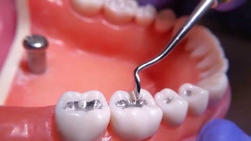 Trám răng bị nhức và đau - Nguyên nhân và cách xử lý 3