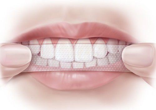 Miếng dán tẩy trắng răng và những lợi ích bạn cần biết 1