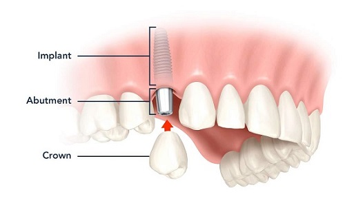 Kỹ thuật trồng răng sứ không mài cho bạn 2 Kỹ thuật trồng răng sứ không mài cho bạn 2