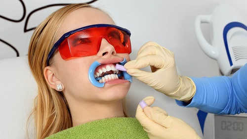 Tẩy trắng răng bằng đèn plasma có hại không? Chuyên gia giải đáp 1