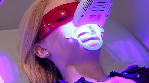 Tẩy trắng răng bằng đèn plasma có hại không? Chuyên gia giải đáp 2