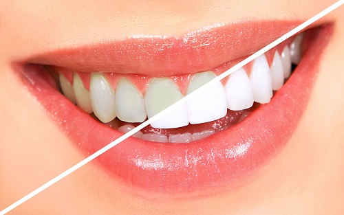 Có nên tẩy trắng răng nhiều lần không? Vì sao 2
