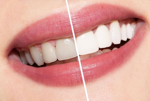 Tẩy trắng răng có ảnh hưởng gì không? Cần lưu ý điều gì? 1