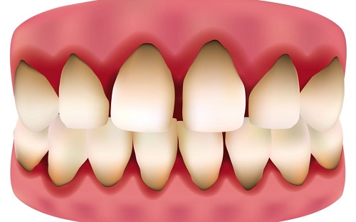 Trồng răng sứ bị đen chân răng phải làm sao? 1