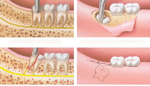 Đau răng khôn dẫn đến đau tai - Nha khoa tư vấn điều trị 3
