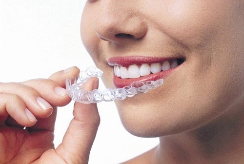Dụng cụ niềng răng tại nhà 3 giai đoạn - Tìm hiểu ngay 3