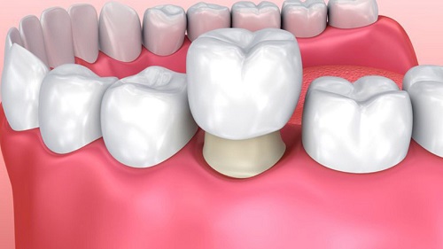 Trồng răng cấm hết bao nhiêu tiền? Chi phí trồng răng 3