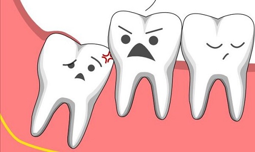 4 răng khôn mọc lệch - Hướng giải quyết từ nha khoa 1
