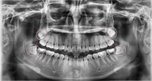 4 răng khôn mọc lệch - Hướng giải quyết từ nha khoa 2 4 răng khôn mọc lệch - Hướng giải quyết từ nha khoa 2