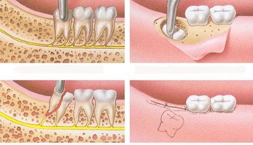 4 răng khôn mọc lệch - Hướng giải quyết từ nha khoa 3